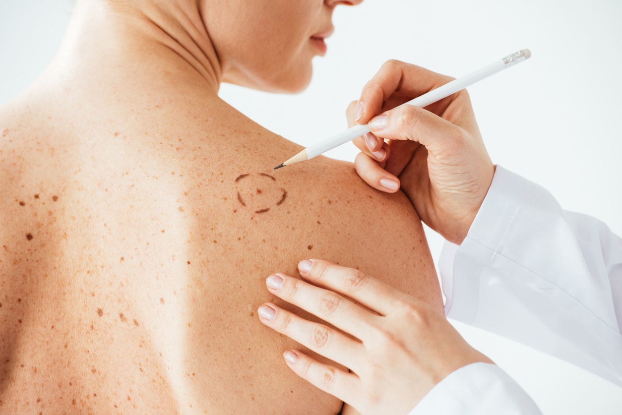 Skin cancer screening